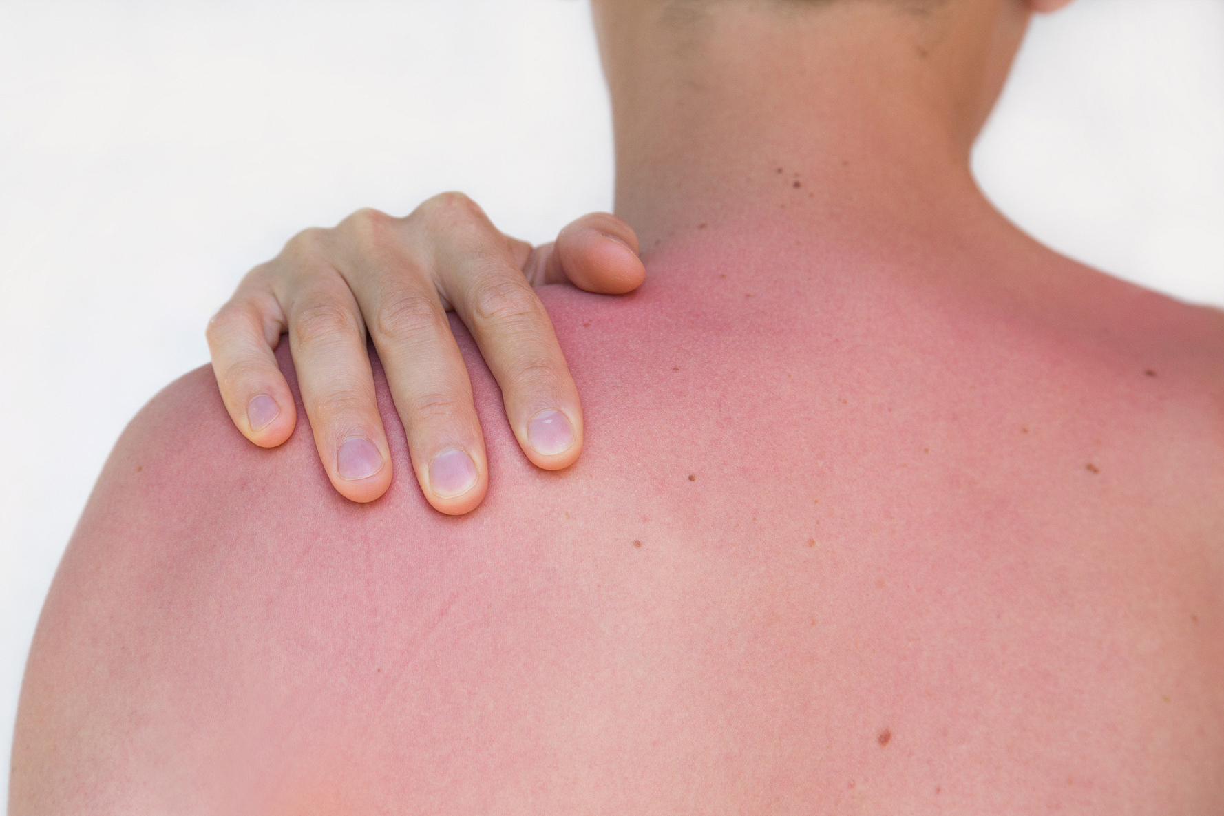 Auf dem Rücken und den Schultern eines Mannes ist Sonnenbrand.