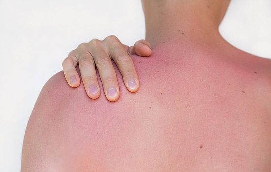 Auf dem Rücken und den Schultern eines Mannes ist Sonnenbrand.