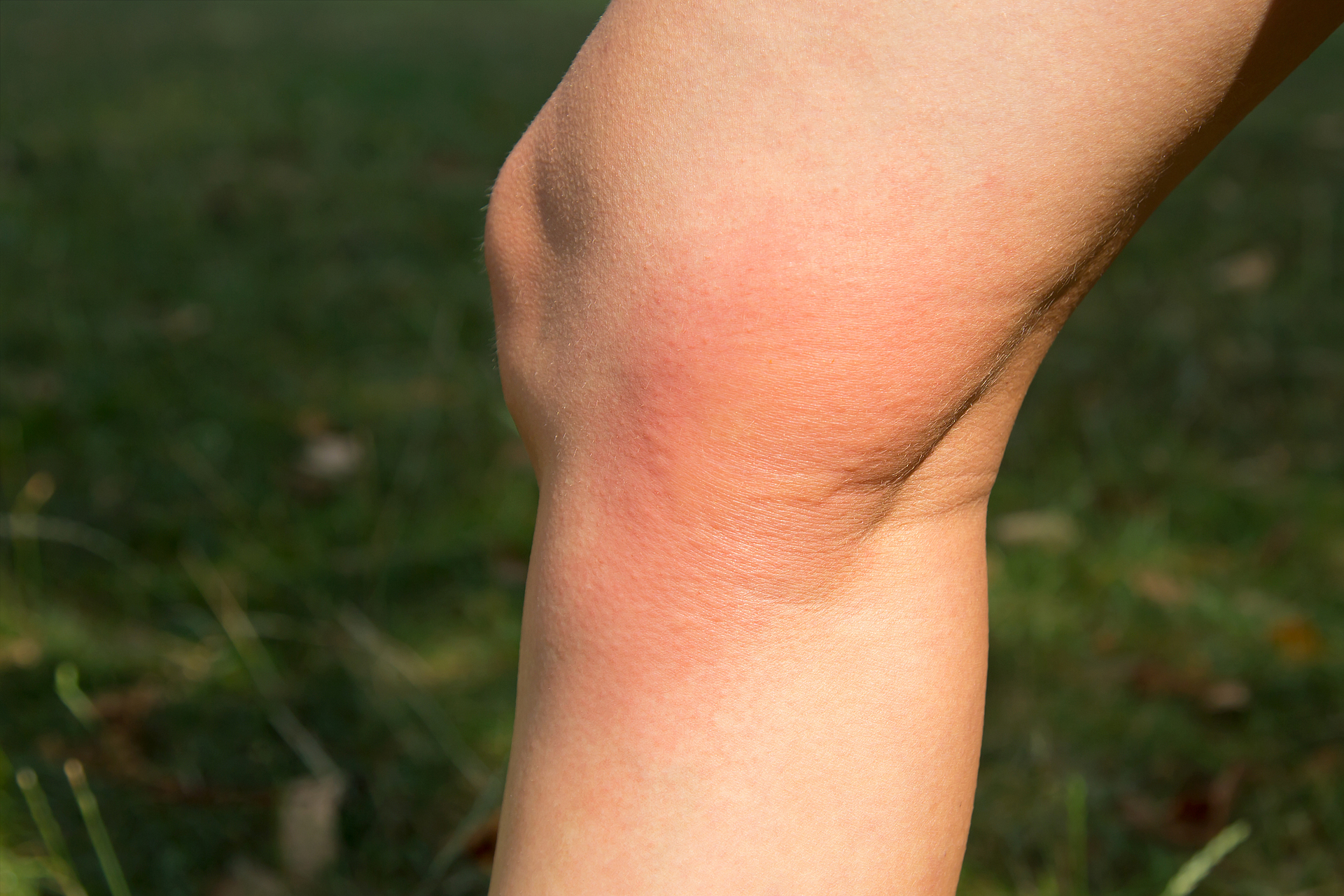 Auf einem Knie gibt es einen geröteten und geschwollenen Fleck nach einem Insektenstich. 